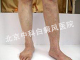 男性白癜风要怎么办
